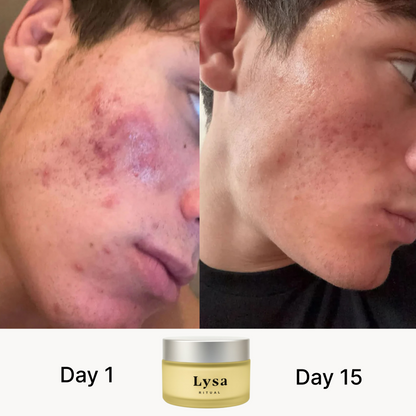 Lysa Acne Scar