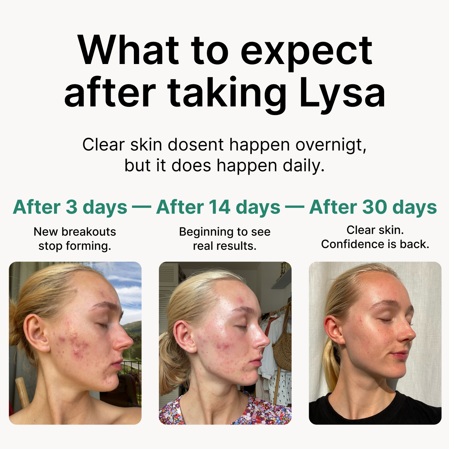 Lysa Acne Gummies