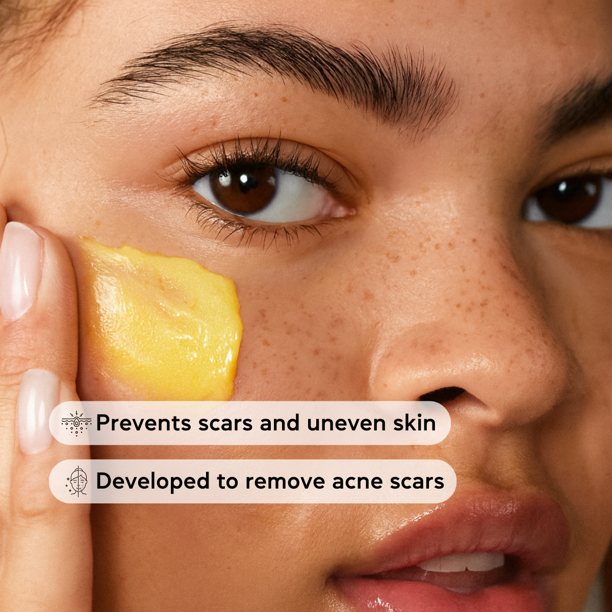 Lysa Acne Scar