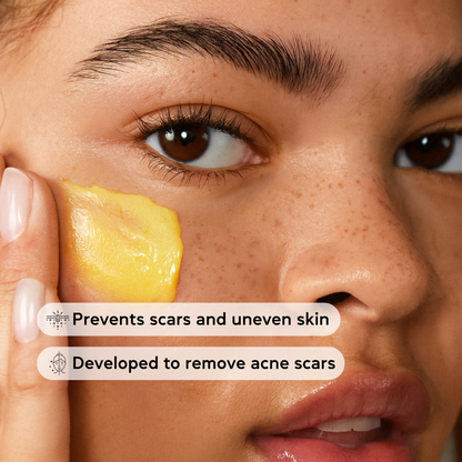 Lysa Acne Scar