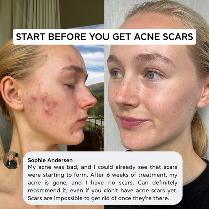The Acne & Scar Ritual