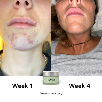 Lysa Acne